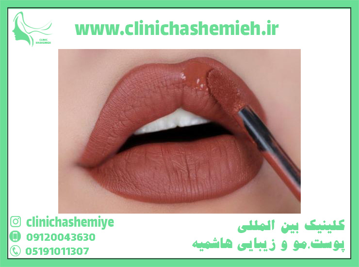 عکس انواع مدل های ژل لب - کلینیک بین المللی پوست و مو زیبایی هاشمیه مشهد